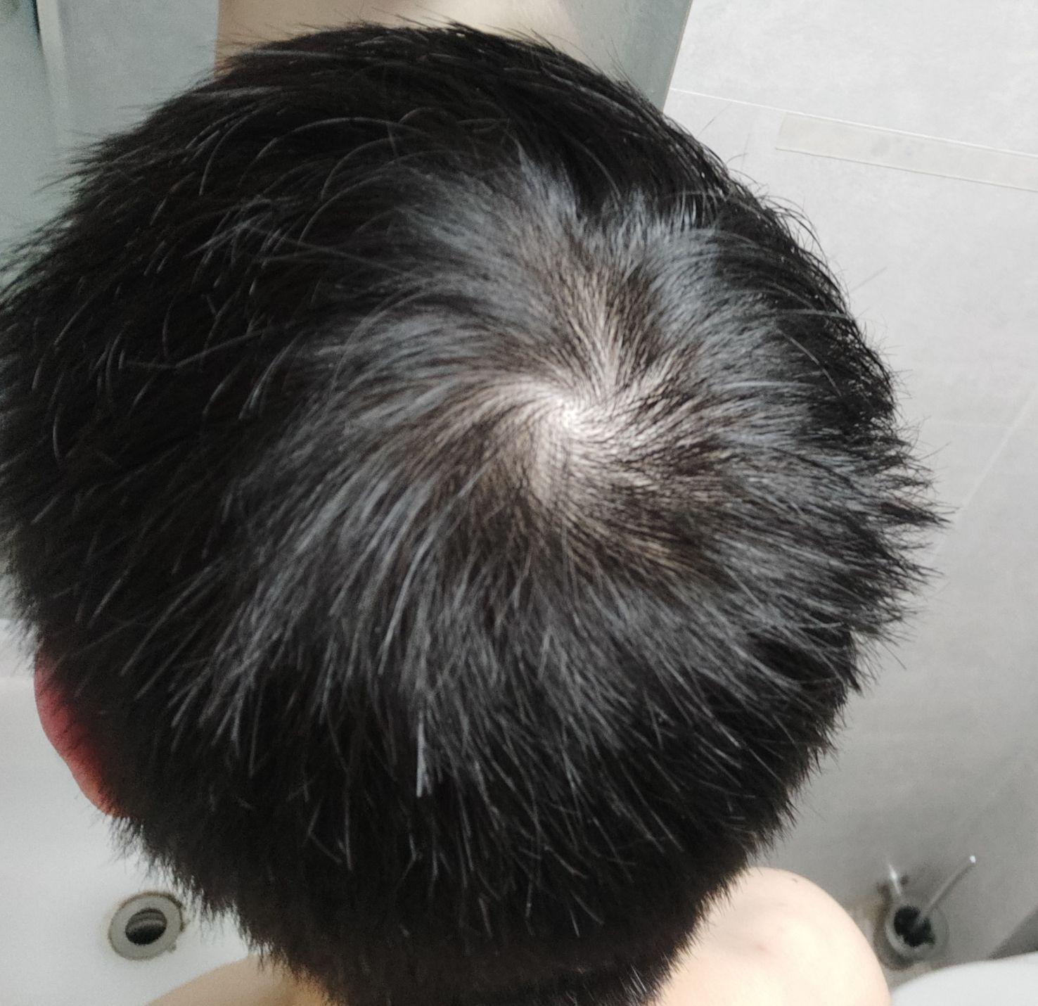 发旋处头发太少了!,我是不是要秃了,怎么办啊! - 知乎