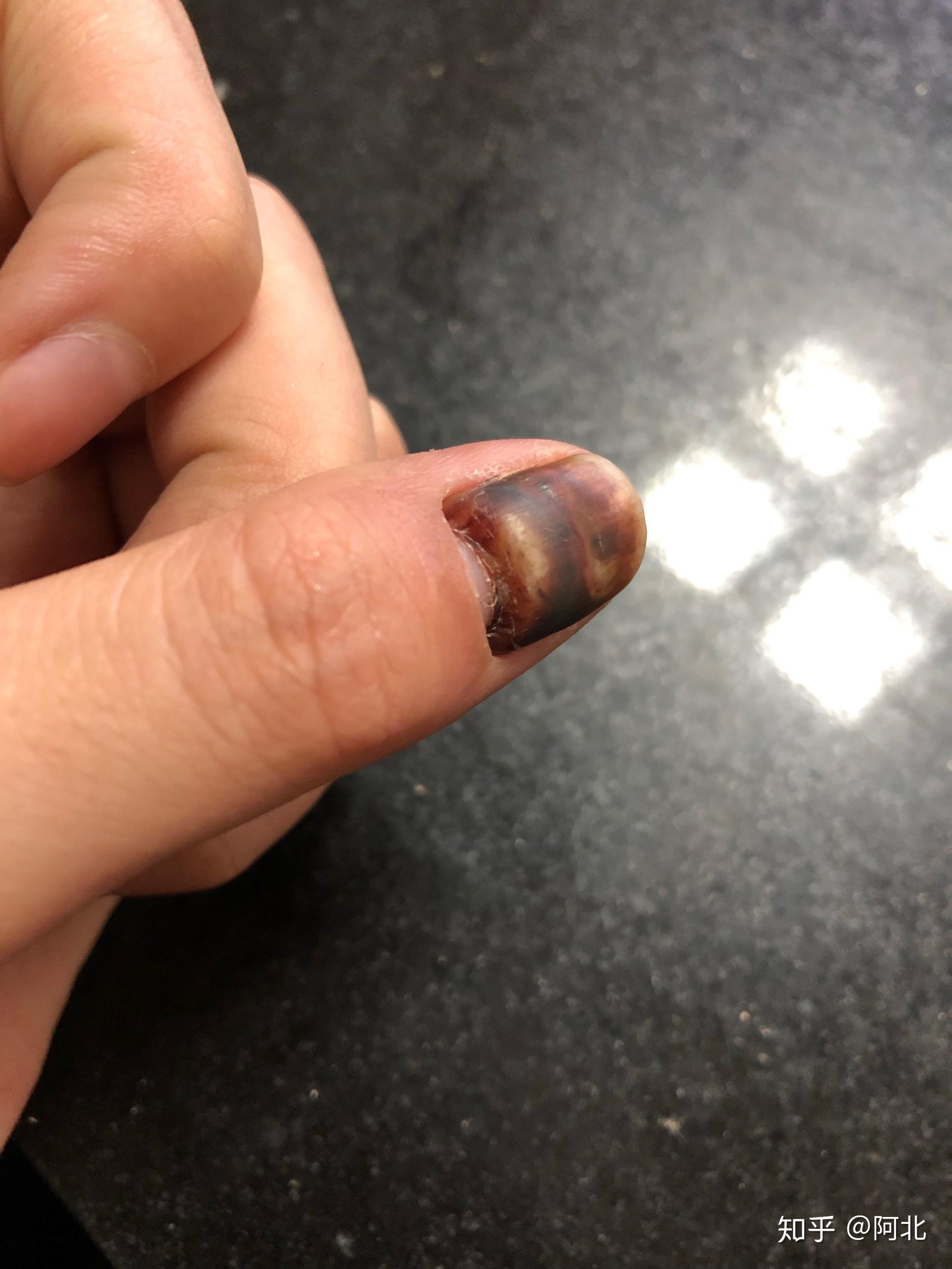手指被门夹肿还夹出淤血是什么感受? - 知乎