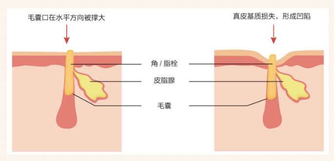 各种类型毛孔说明图图片