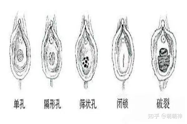石女做阴道重建术只为有男人要