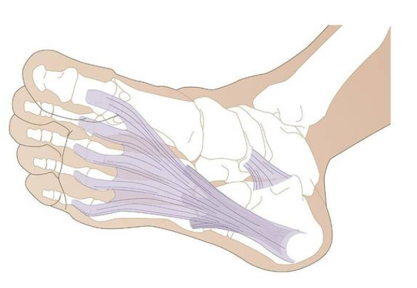 足底筋膜炎完整治疗方案