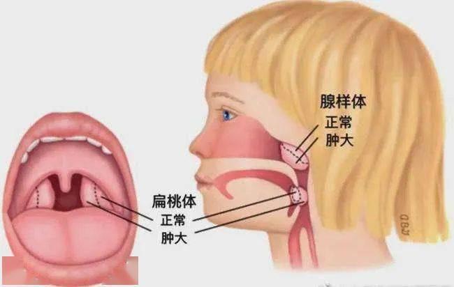 孩子脾气越来越差?腺样体肥大竟会影响性格! - 知乎