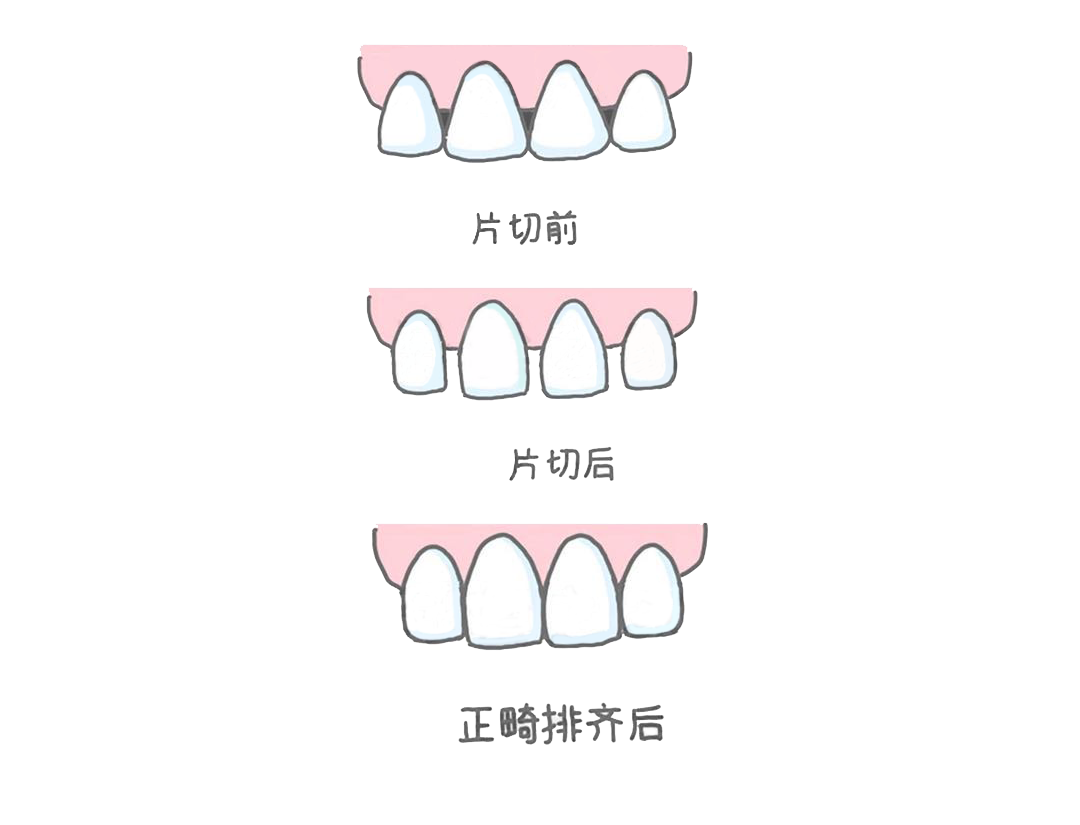 但它也不是万能的哦很多情况下,医生也是不推荐使用片切的比如,当牙齿