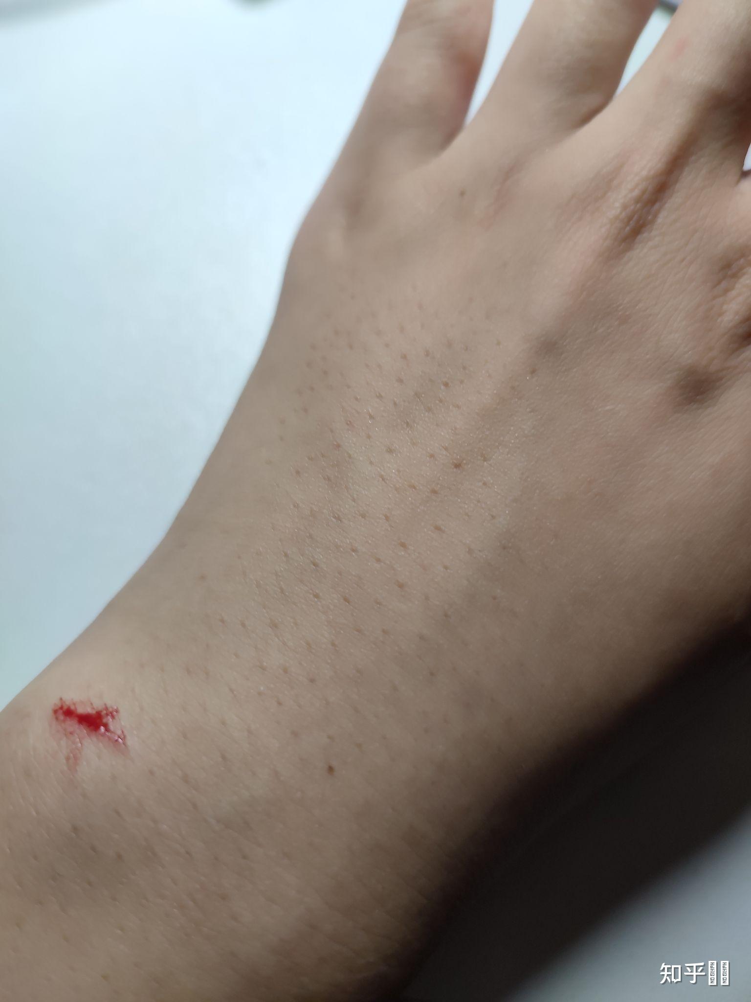 我是女生手背上汗毛很多毛孔特别大密密麻麻的大家有紧毛孔的办法吗