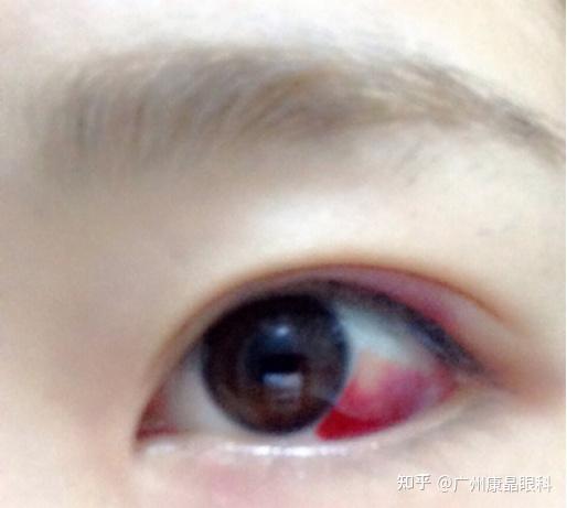 被通红的眼睛吓一跳?先别怕,这几种情况不用太担心 - 知乎
