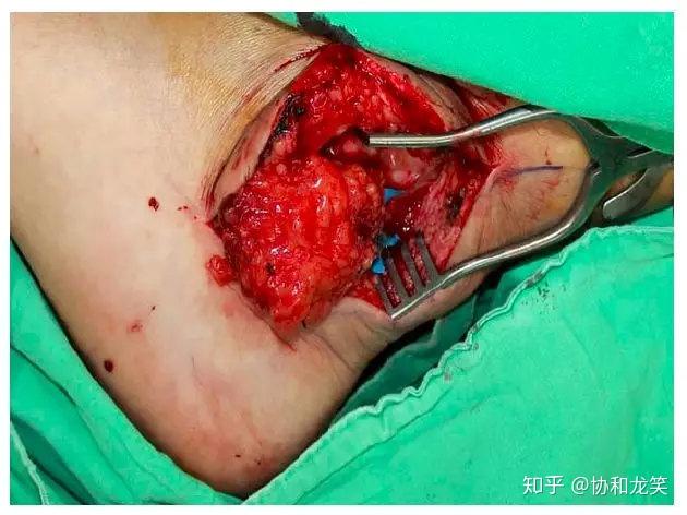 带血管蒂阑尾淋巴结转移治疗肢体淋巴水肿