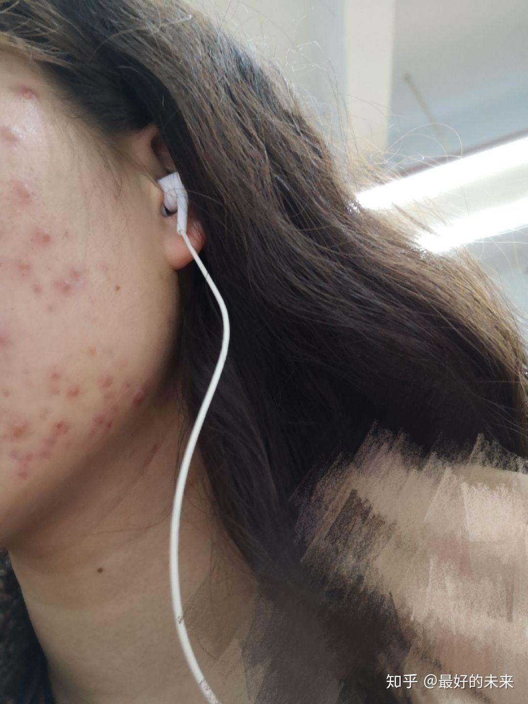 但是应该能看到有囊肿,结节,明显凸起,事实上比照片拍出来严重,会留下