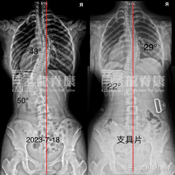 脊柱侧弯治疗3个月时间,体表大改善基本对称 - 知乎