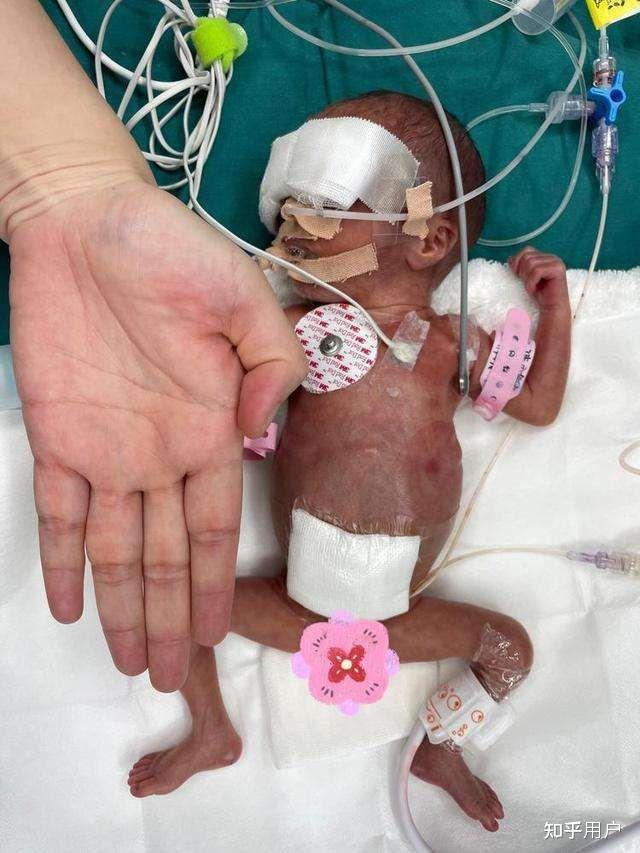 老婆早产才26周,出生时700克,产儿可以健康成长吗?