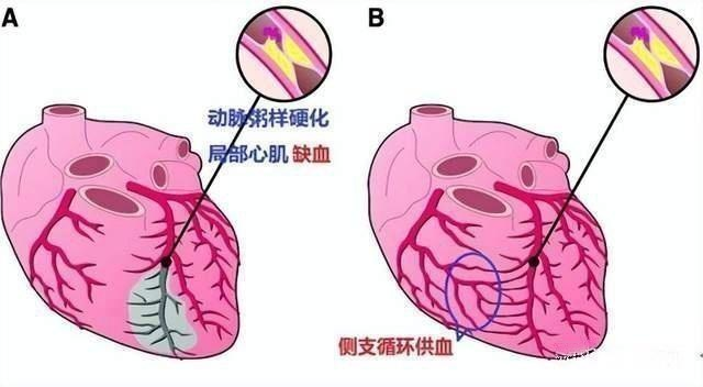 心梗患者为什么要吃糖(心梗患者为什么不能吃盐)