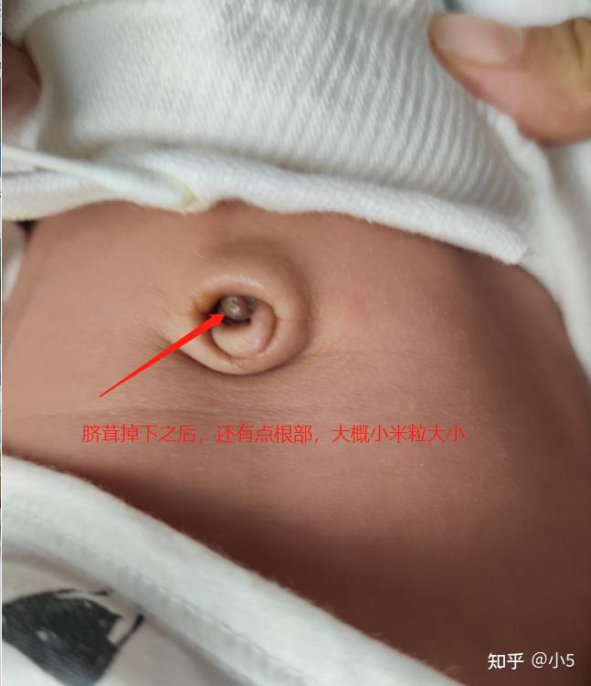 大神们,请教一下,听说盐敷法可以治疗宝宝脐茸,国外医生都会建议家长