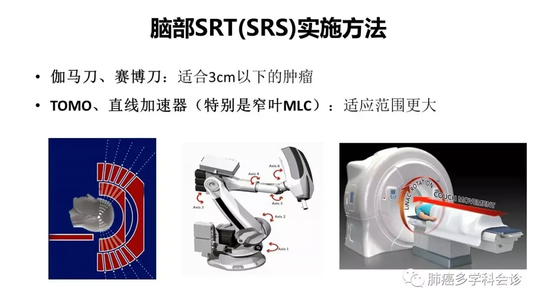 SRS 和全脑放疗怎么选择用才能让肺癌脑转移患者最大获益? - 知乎
