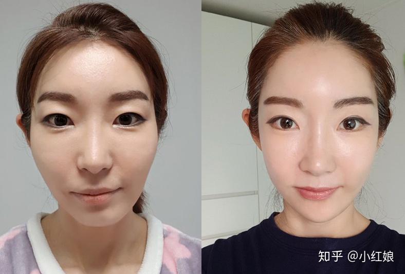 而正确的审美和严谨的方案设计正是李真秀在轮廓手术方面的拿手点之一