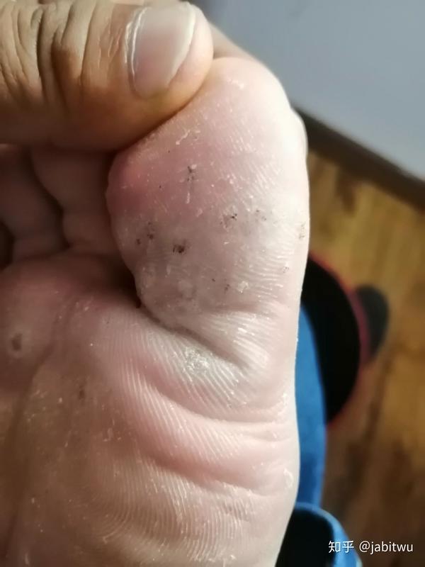 跖疣原来这么治白白浪费那么多钱和时间