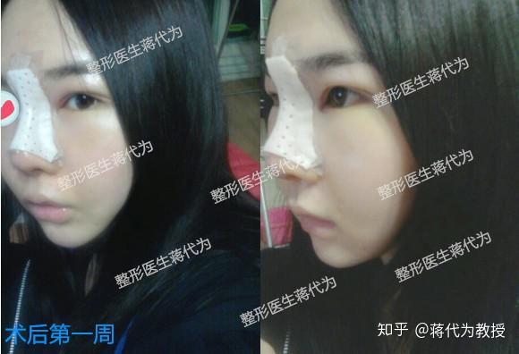 咋样让鼻头变小一点 v2-b7fe025ff71127e490adea1f091e7c34_r.jpg