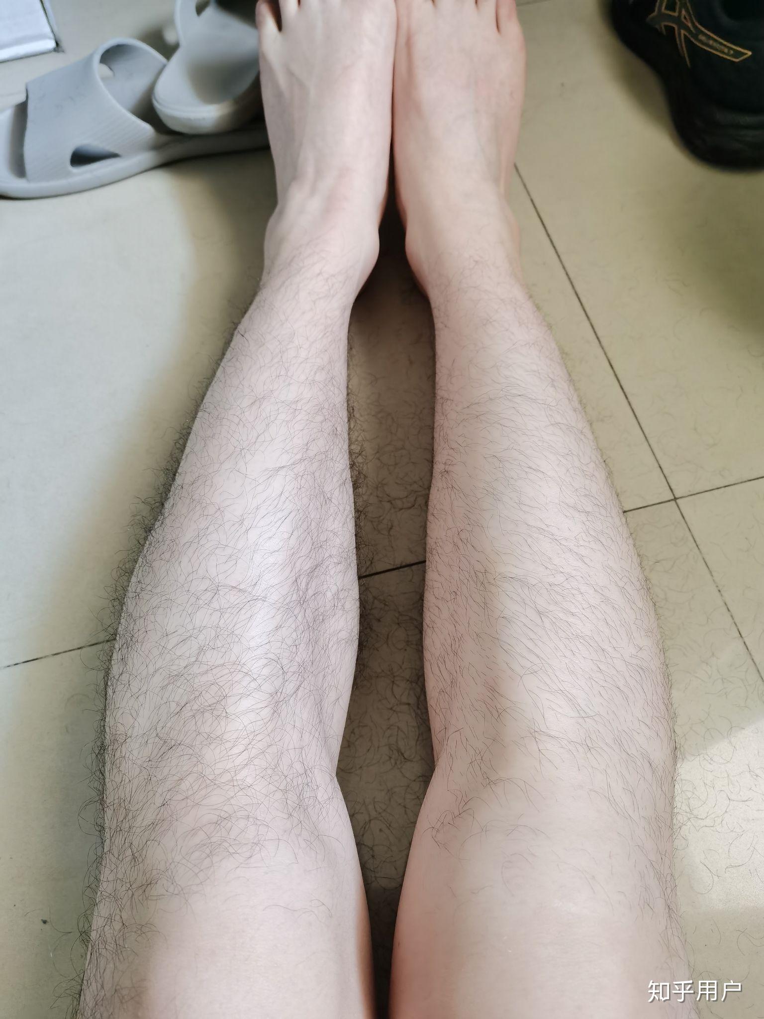 男生腿毛浓密怎么办
