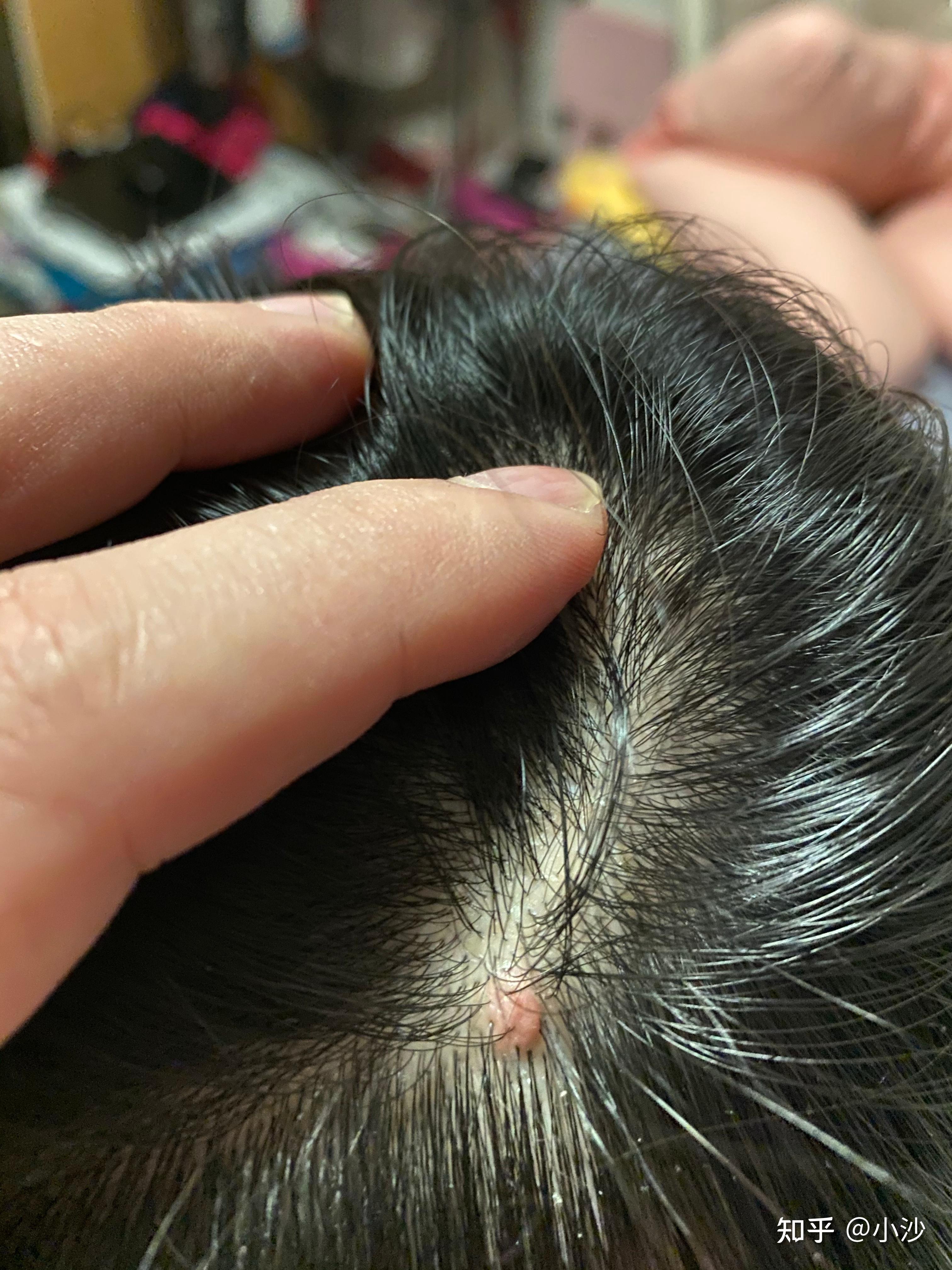 我的头皮上长了一个人肉疙瘩? - 知乎