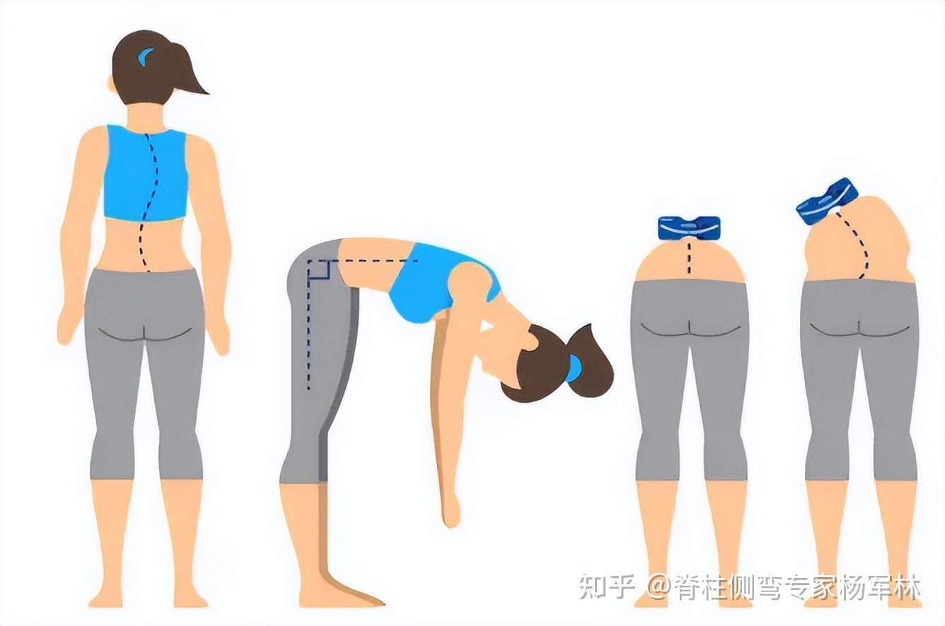 警惕!破坏美感的“剃刀背” ,可能是脊柱侧弯引起的! - 知乎