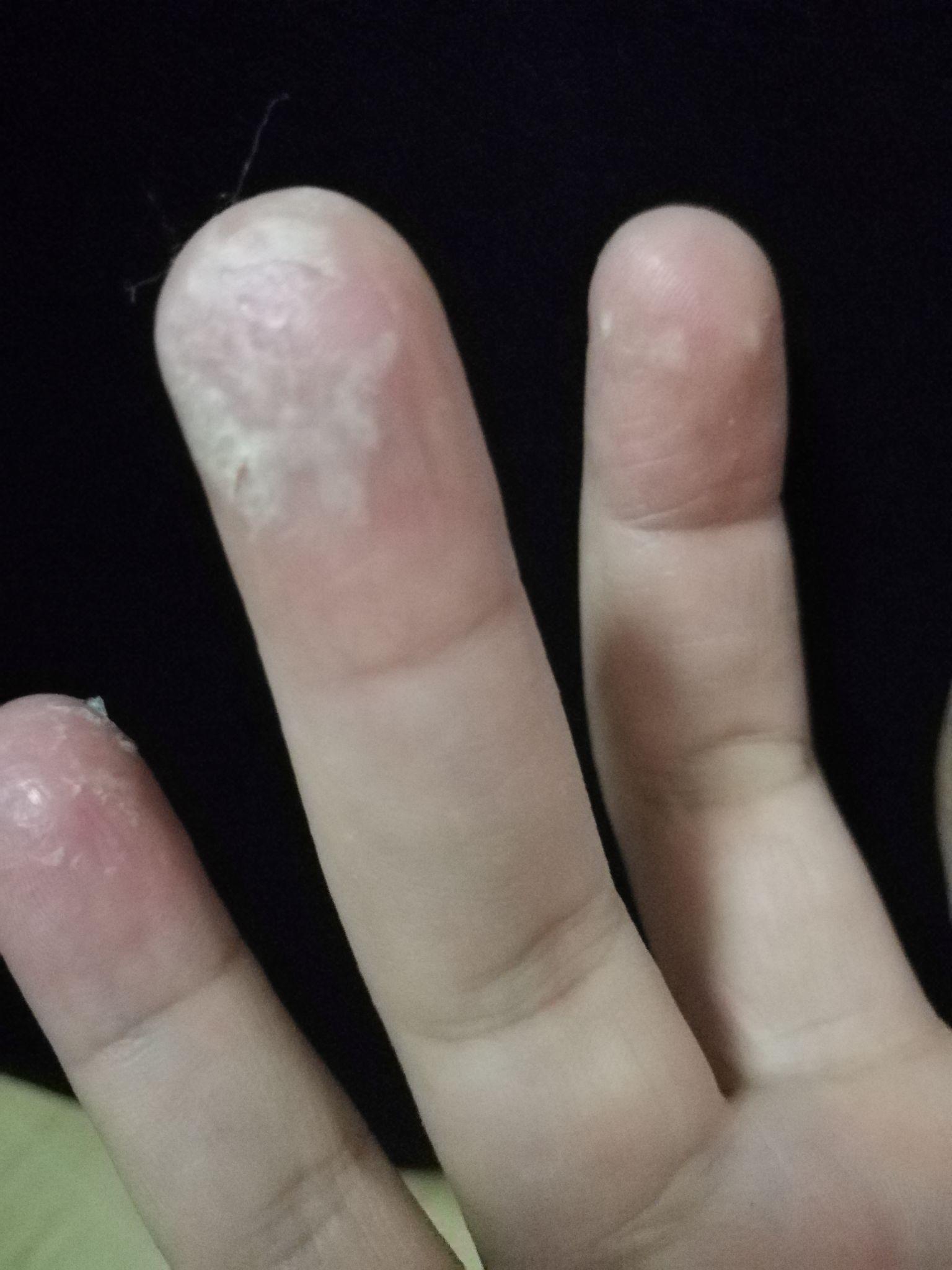 手指脱皮起泡