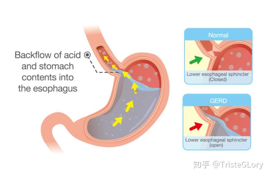 胸痛不是冠心病竟是胃病出現這6個症狀病根十有八九也在胃