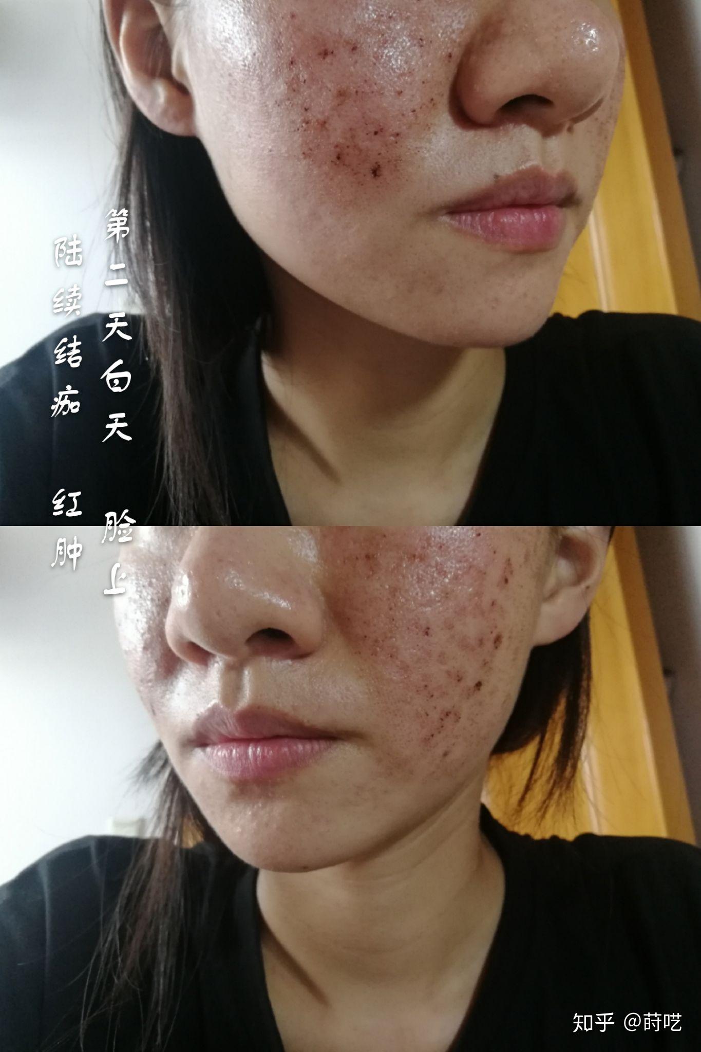 点阵激光第一次变化记