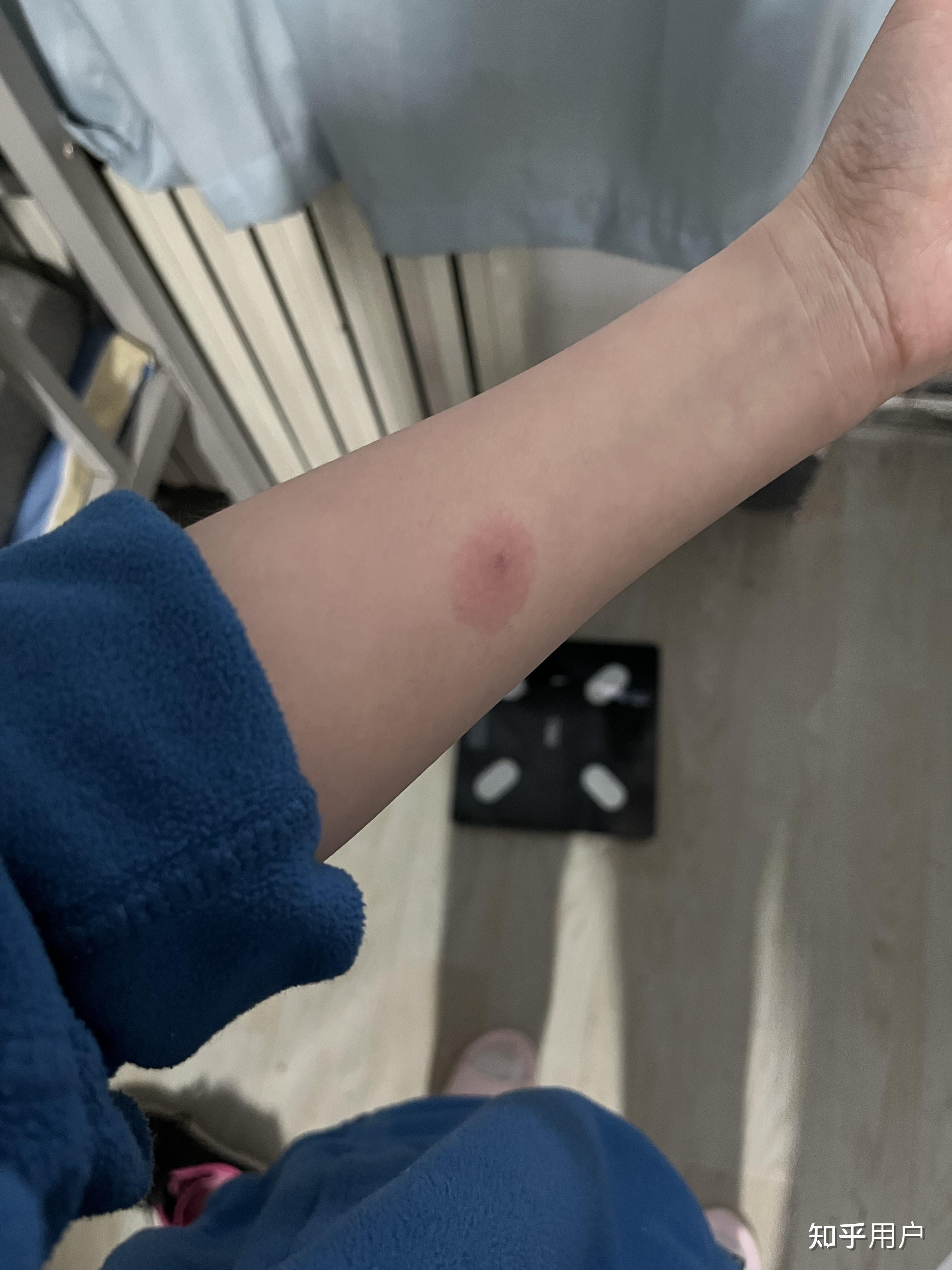 ppd皮试后这个样子怎么办? - 知乎