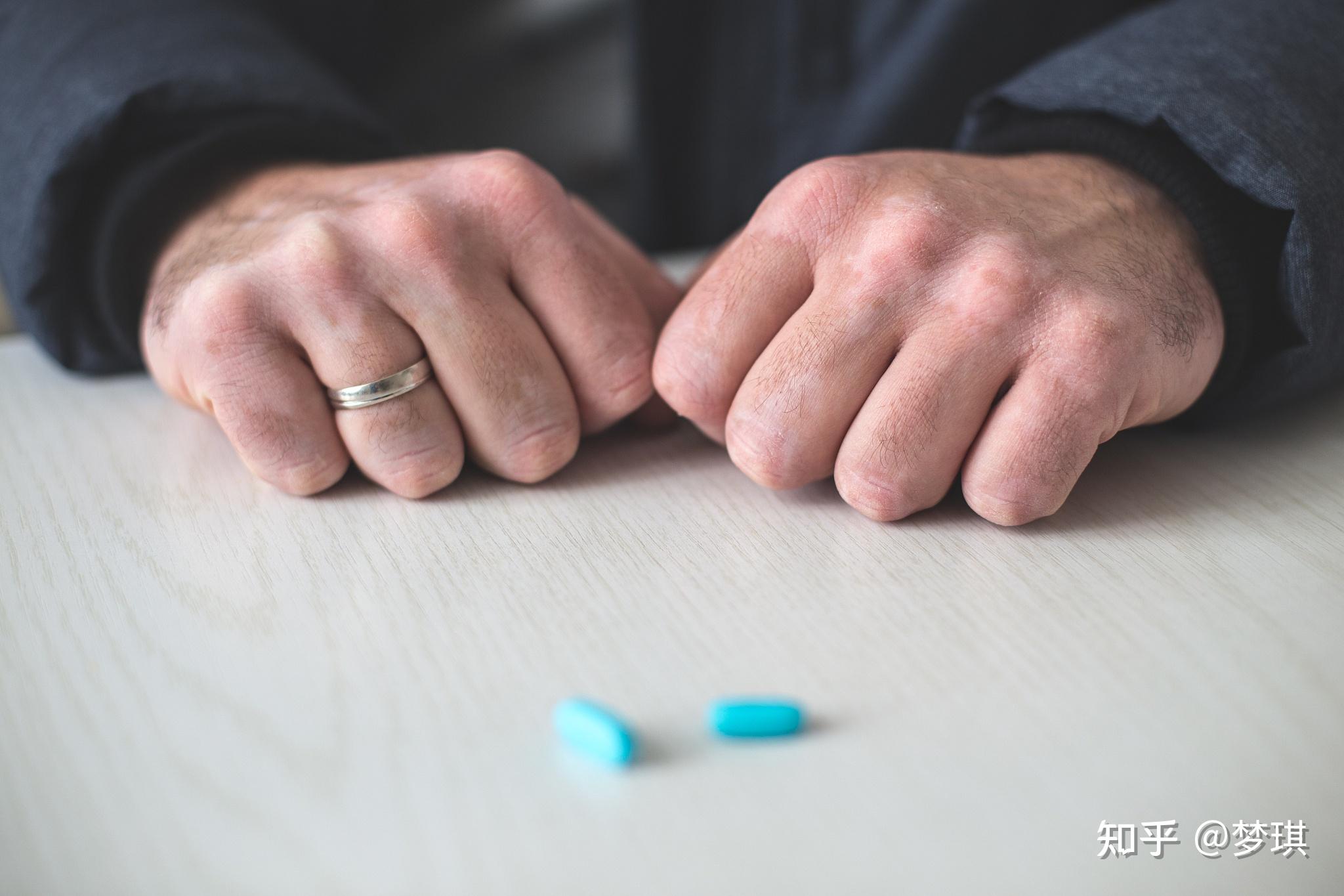 性欲低下是一种比较常见的性功能障碍疾病,临床上在女性群体中相对更