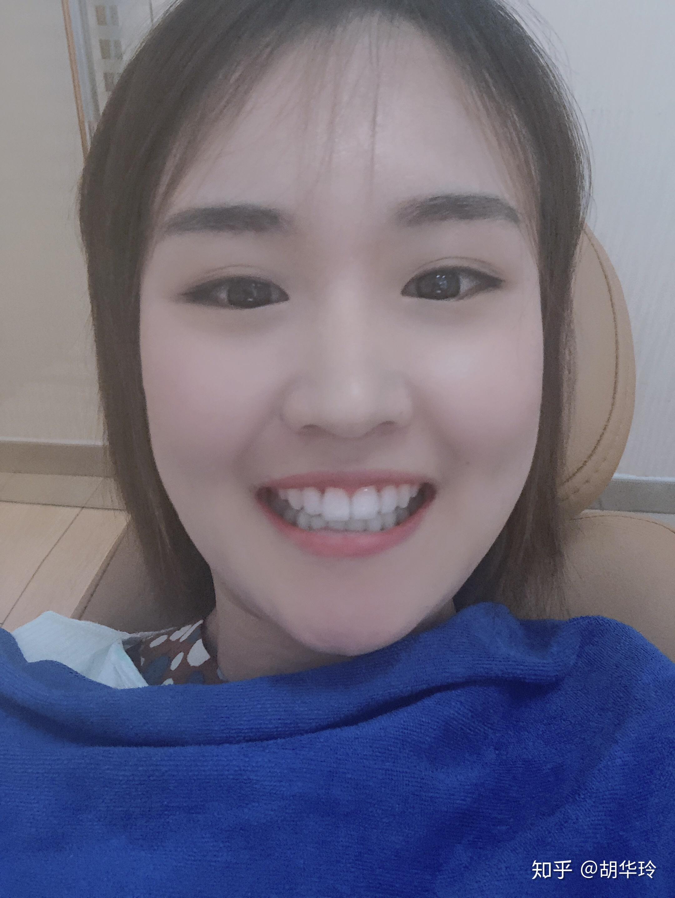 女生矫正牙齿后变美是怎样的体验?