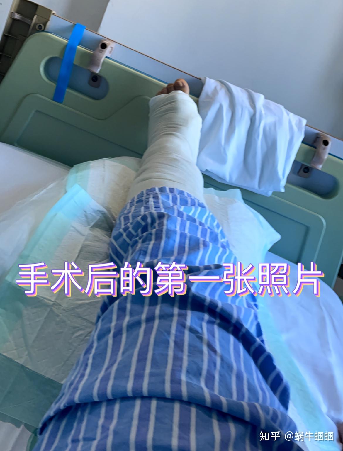 一名副舟骨患者的分享