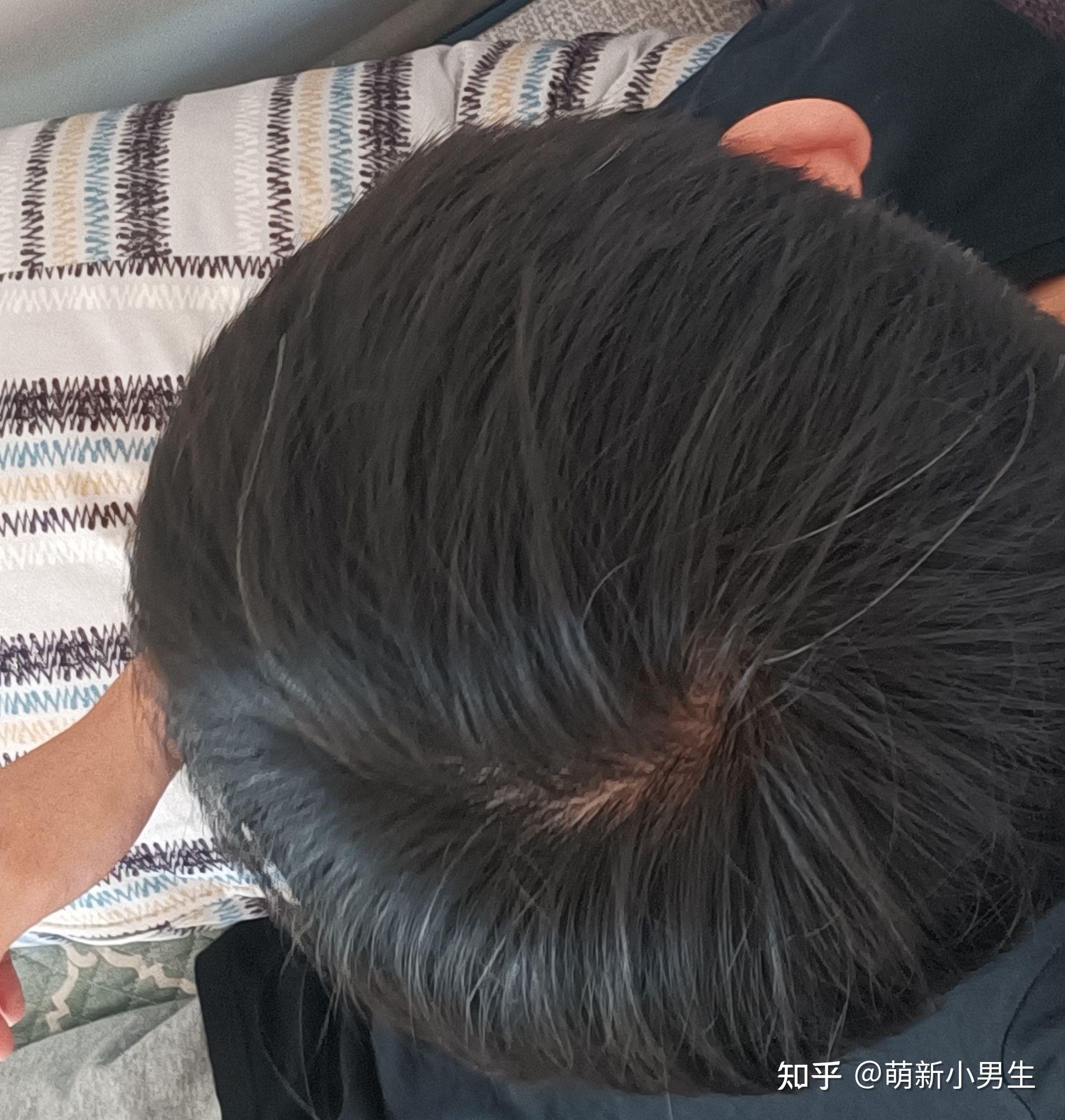 什么样子的发旋是正常的啊?