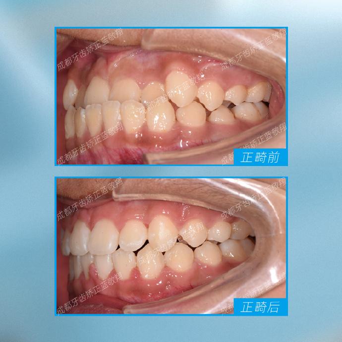 成都牙齒矯正成年了還能矯正地包天嗎