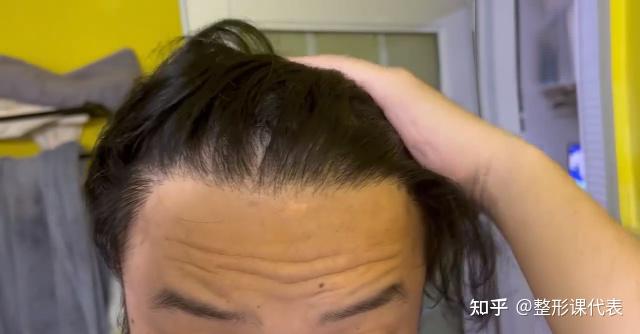 王禹植发医生多大(王禹植发医生怎么样)