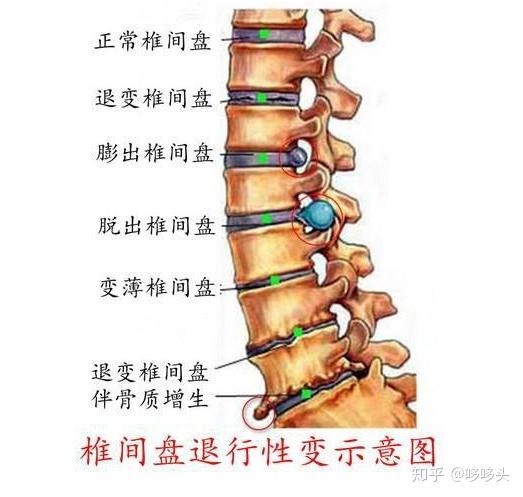 腰椎退行性变是什么意思,严重吗?如何有效治疗