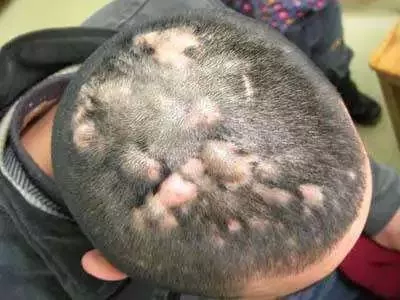 什么是穿掘性毛囊炎中医怎么治