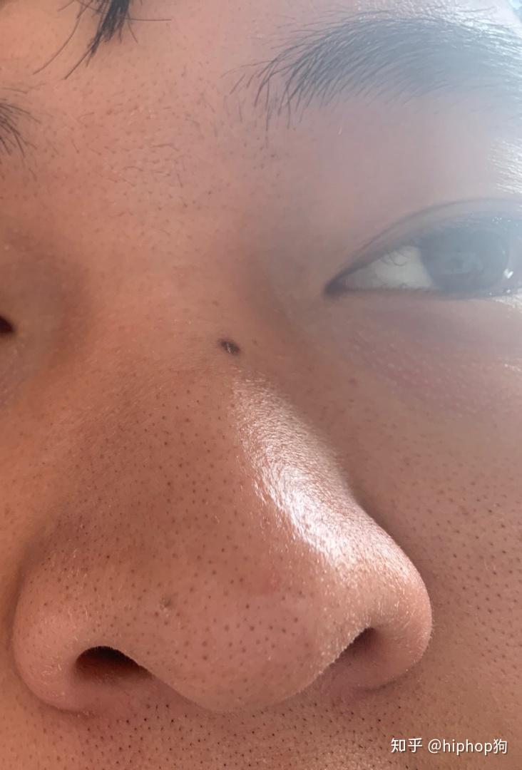 谁能告诉我我鼻子的脸颊上的黑头怎么去除