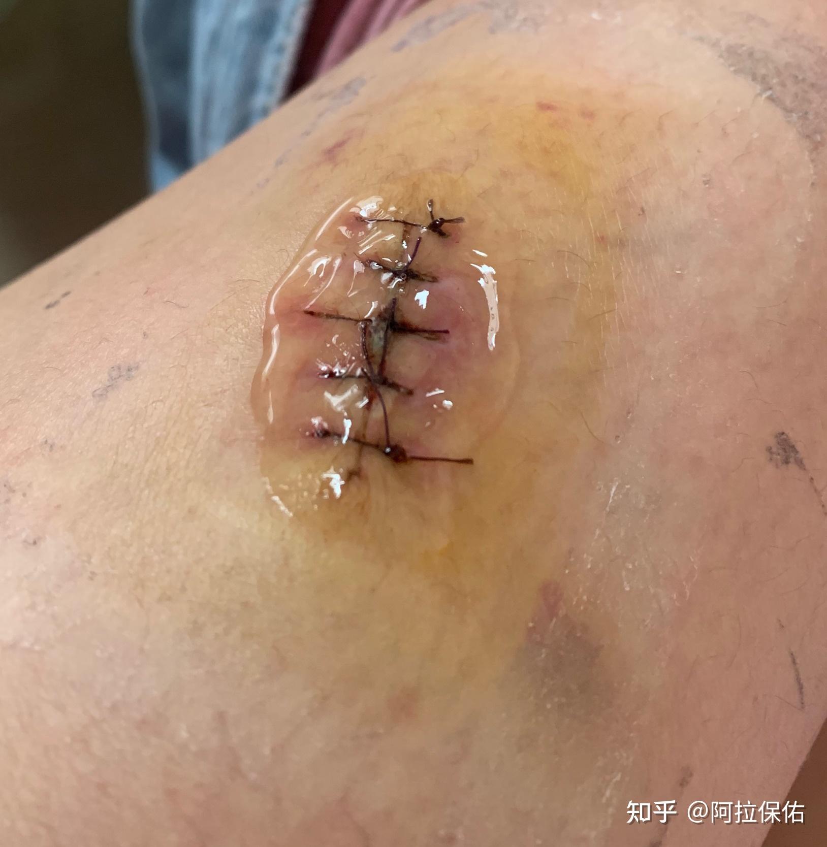 痦子切除经历分享