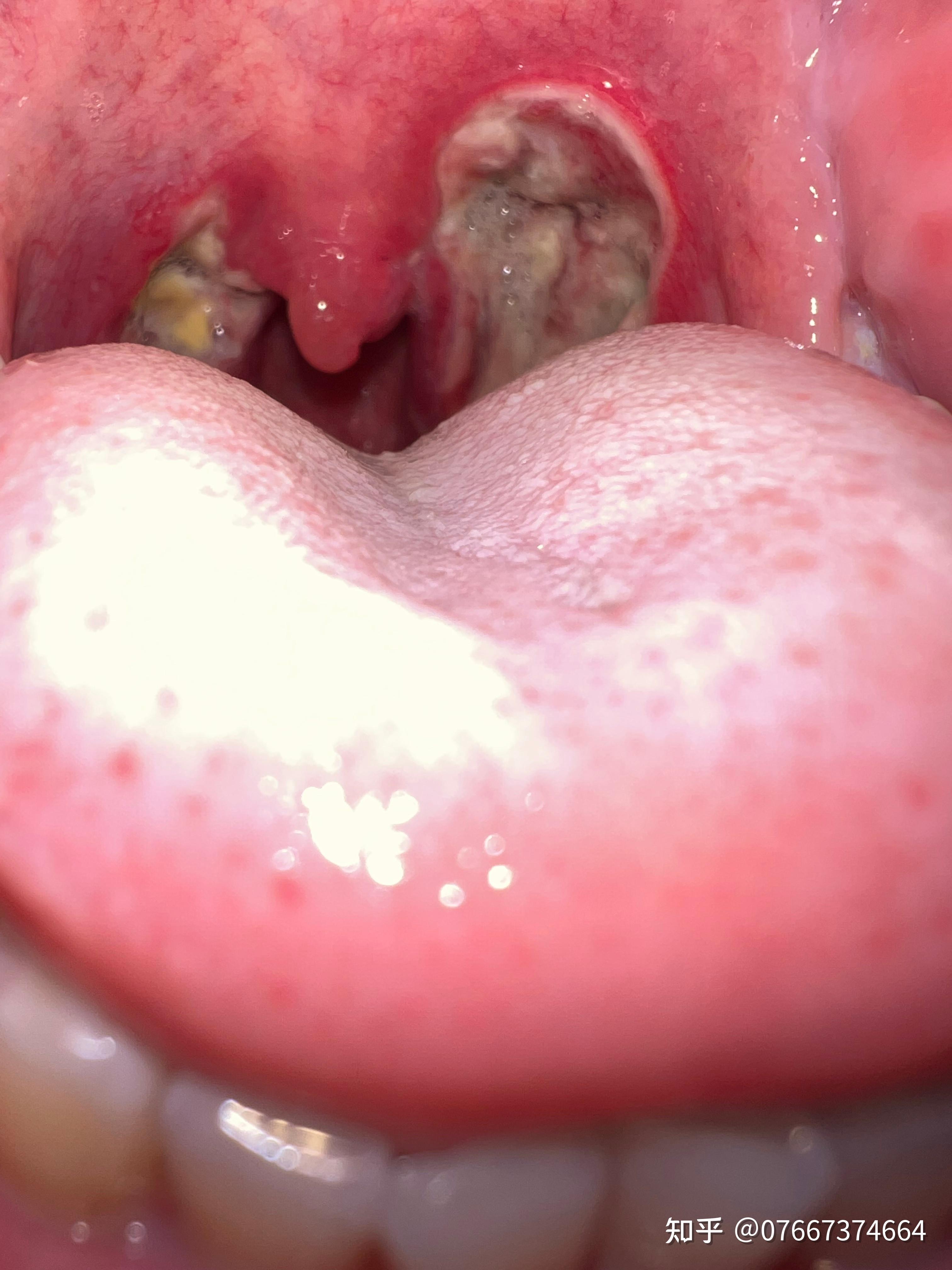 咽喉劈裂的位置图片图片