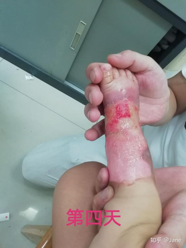 宝宝烫伤恢复到祛疤过程记录