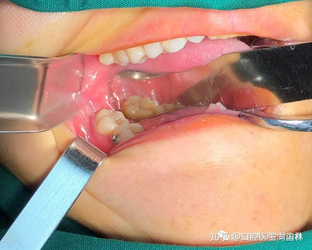 智齿案例全麻舒适化下超声骨刀微创拔除全口埋伏阻生智齿