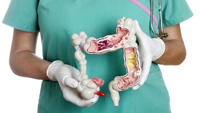 筛查或可降低约53结肠癌死亡率肠镜你做了吗