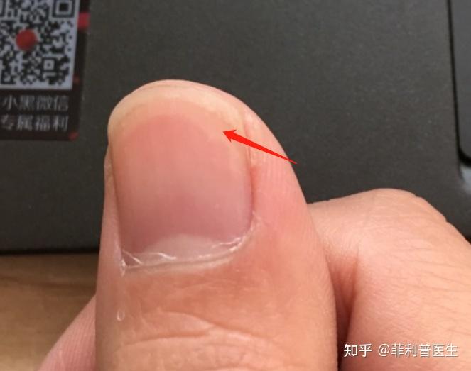 指甲前端有白色圆弧线,每个指甲都有,是什么原因? - 知乎