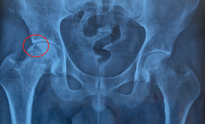 怎么才算确诊股骨头坏死 v2-b94f30f0d3c72c5034e4d25bb427940f_1440w.jpg?source=172ae18b