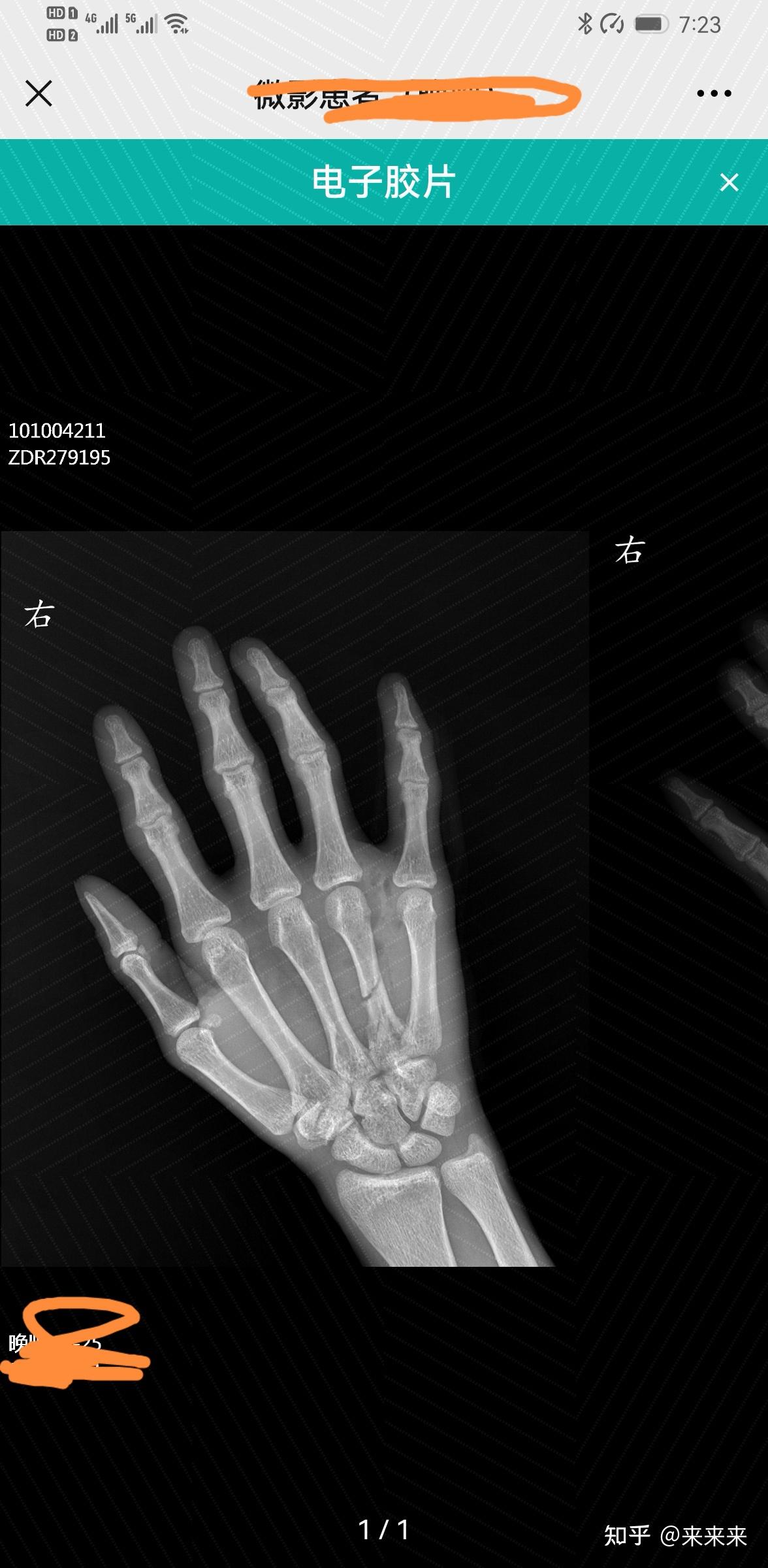 右手第四掌骨骨折保守治疗的第16天,恢复的是否不太理想? 