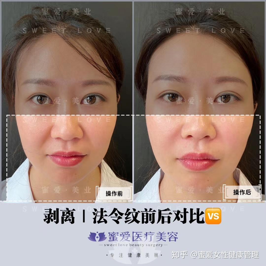 微整形中什么是剥离可以改善面部衰老和抗衰的效果吗