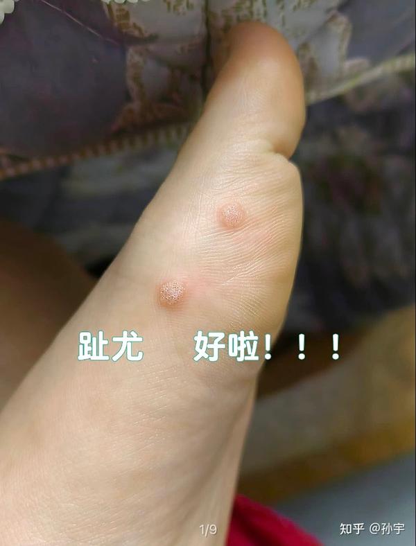 趾疣好啦（完整记录过程） - 知乎