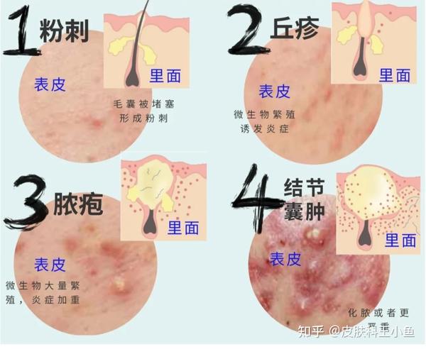 痘痘消了又长,如何28天快速祛除脸上的痘痘?【皮肤科医生】教你最详细祛痘步骤攻略,油痘肌照这篇学就够了~ - 知乎