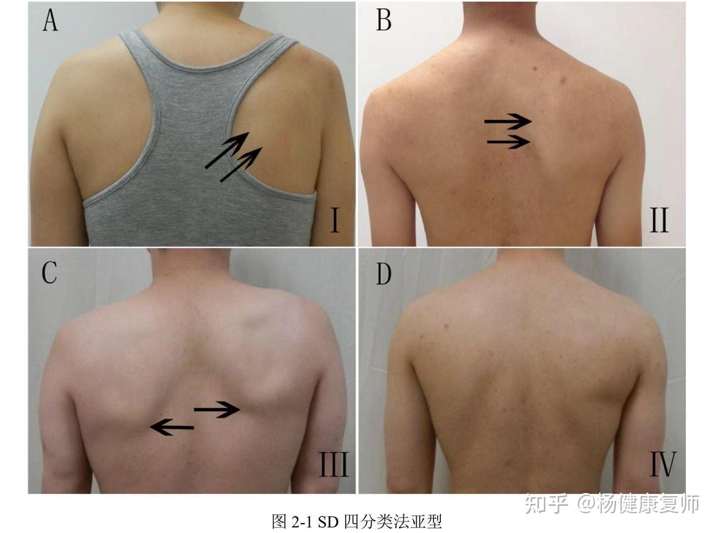 肩康复必要解剖——肩胛关节、肩胸关节主要肌肉群 - 知乎