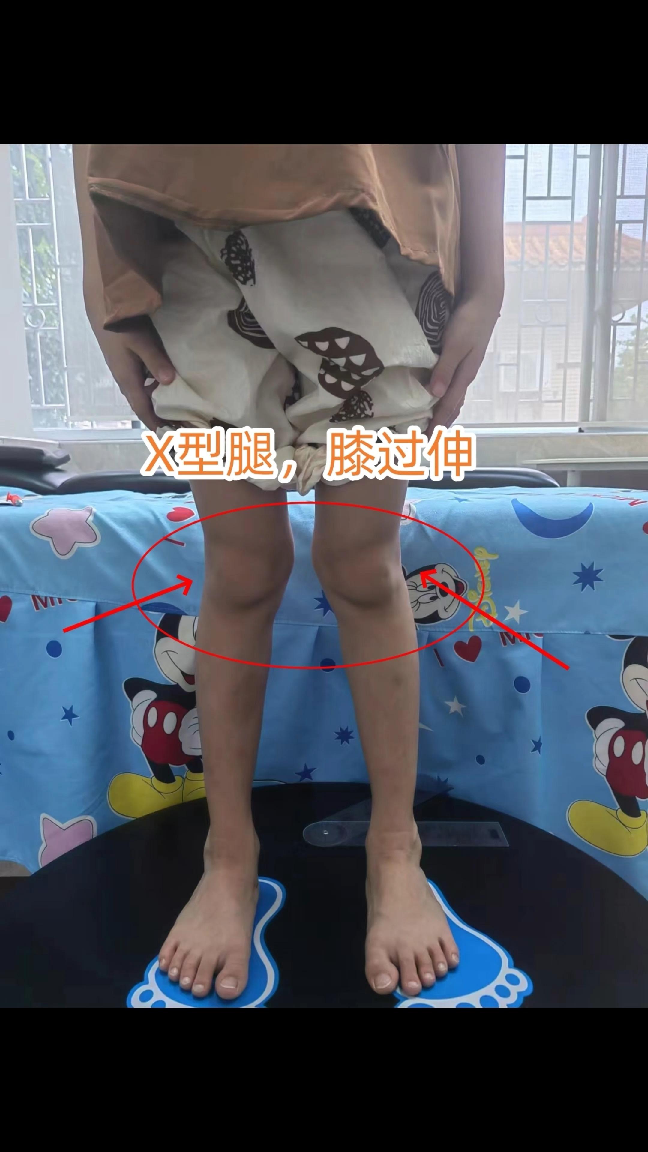 6岁小朋友扁平足x型腿膝超伸内八步态测评