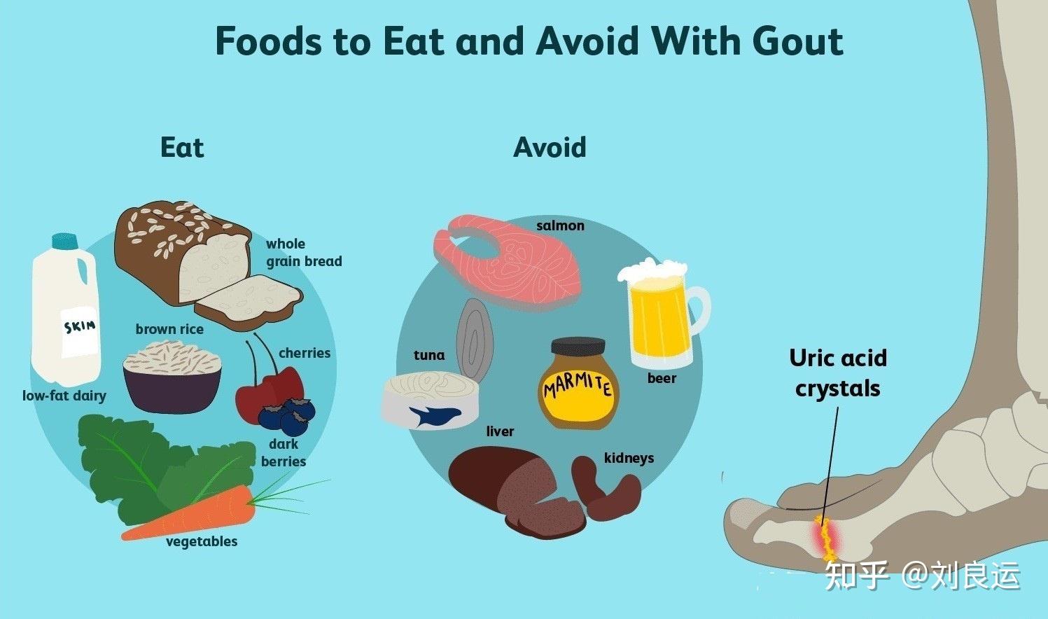 患上痛风只需要控制饮食中的嘌呤含量？错，食物热量也要控制 知乎 5999