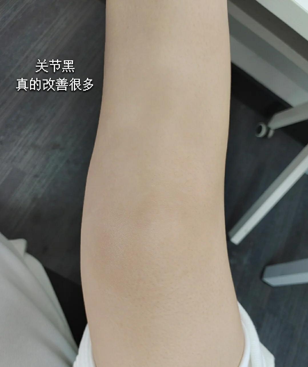 膝盖很黑,怎么变白? - 知乎